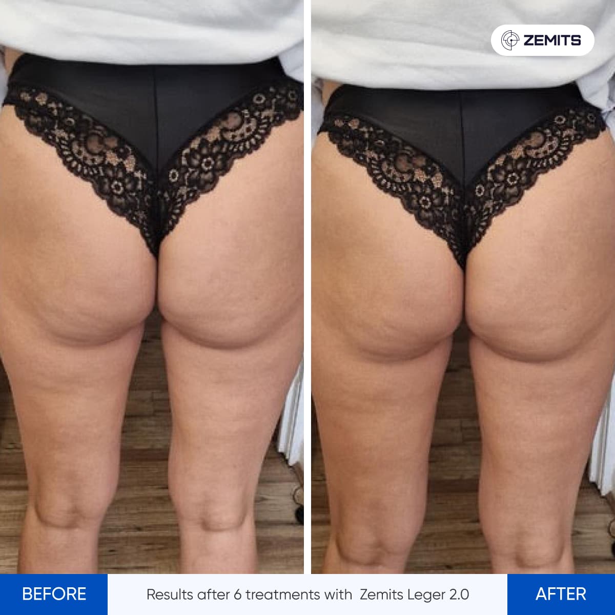 Zemits Leger 2.0 Body Contouring Before and After