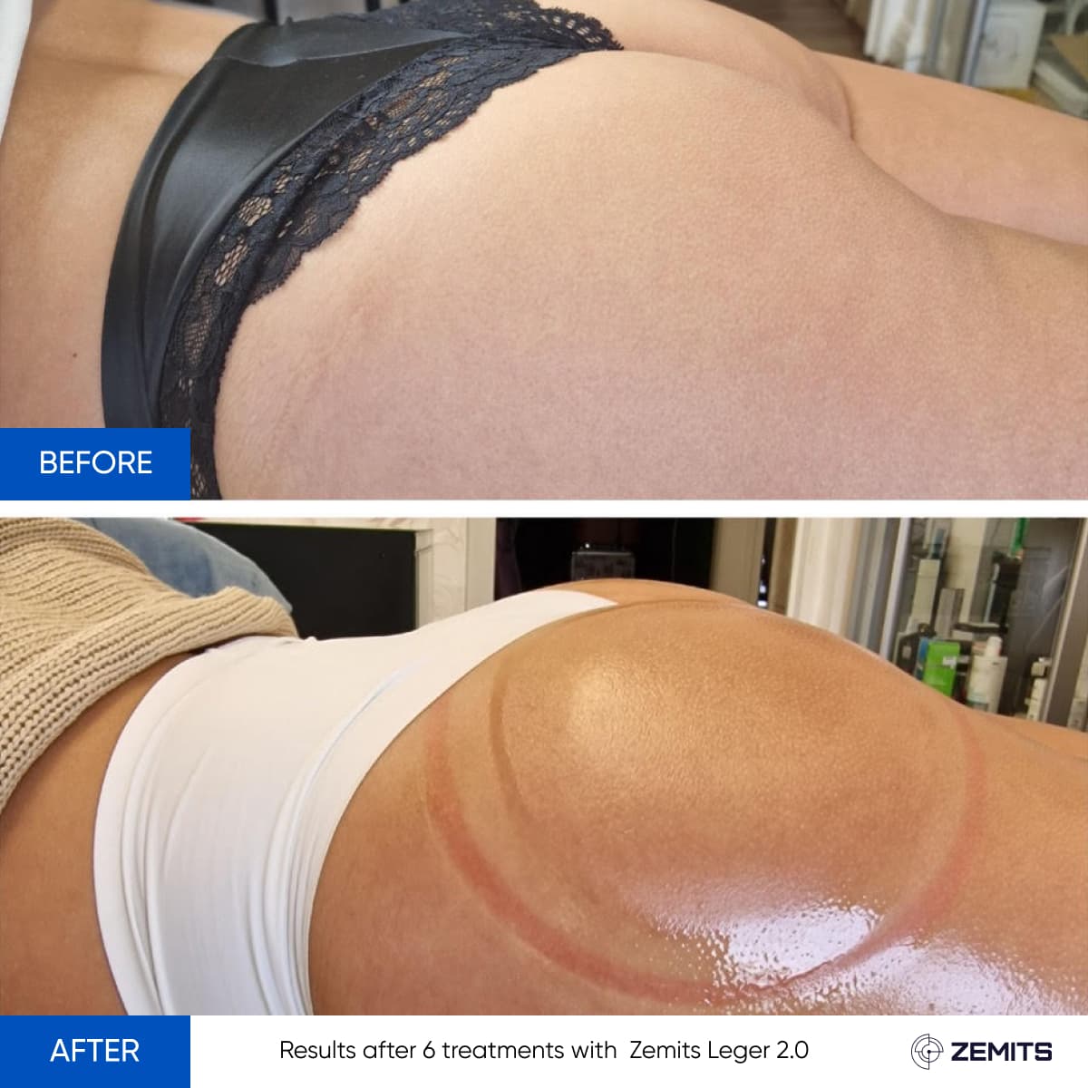 Zemits Leger 2.0 Stomach Contouring Before and After
