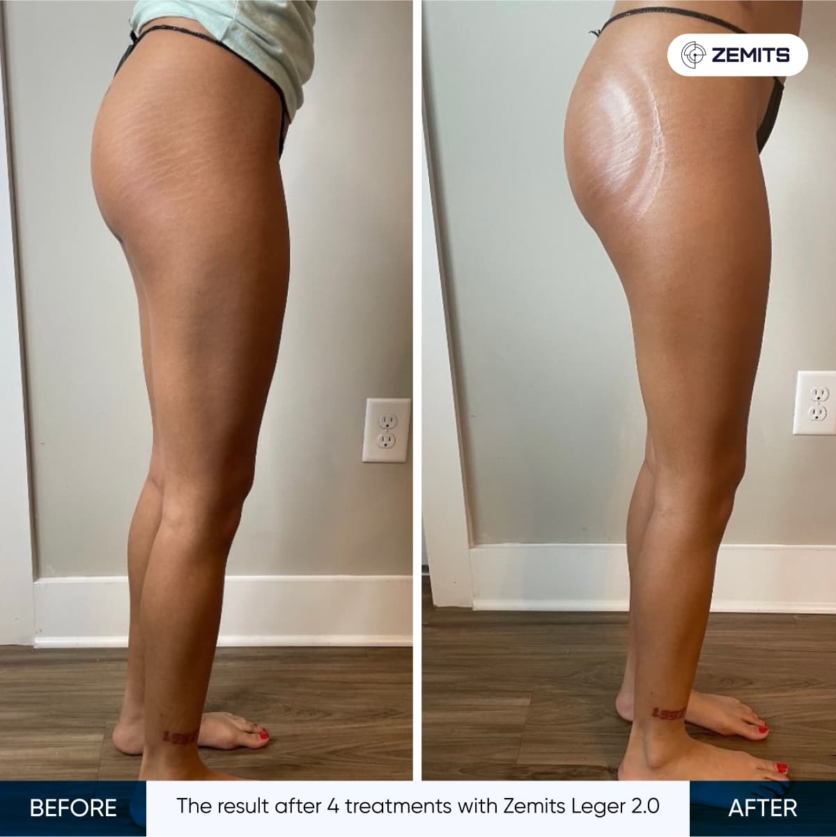 Zemits Leger 2.0 Vacuum Massage Results