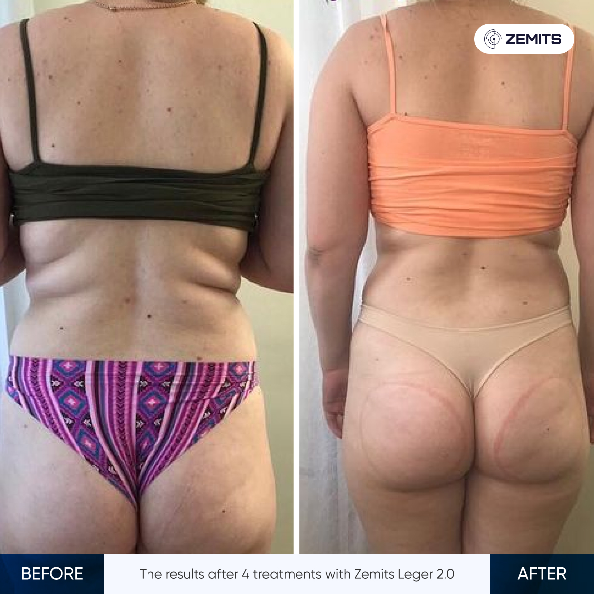 Zemits Leger 2.0 Treatment