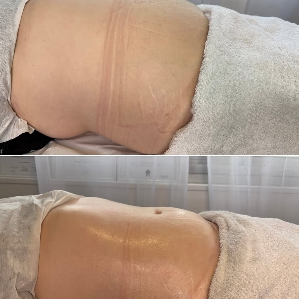 Zemits Leger 2.0 Body Contouring Before and After