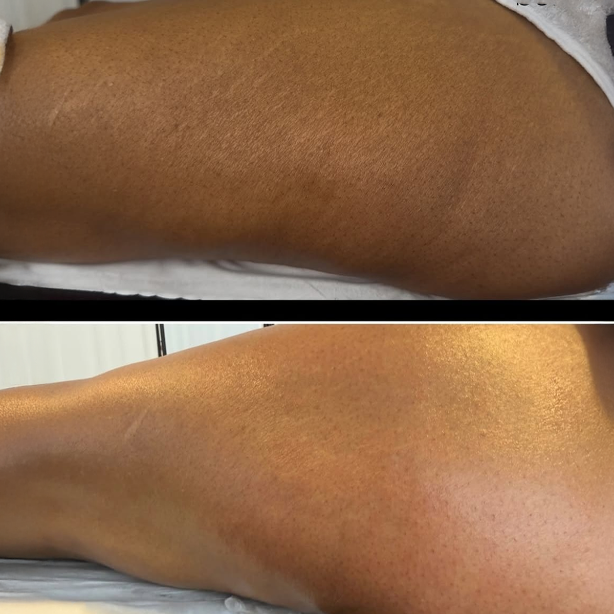 Cellulite Treatment