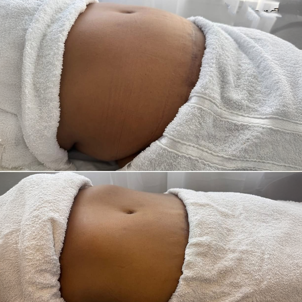 Zemits Leger 2.0 Stomach Contouring Before and After