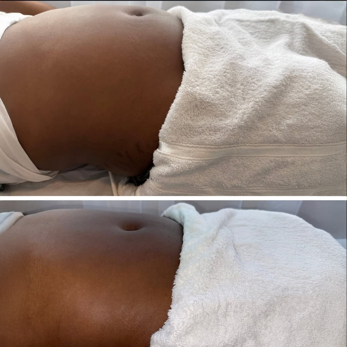 Zemits Leger 2.0 Vacuum Massage Results